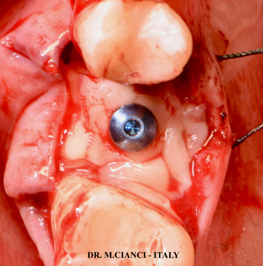 Fig. 9 - Membrane di PRGF® frazione 2 e 1.