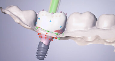 The Straumann Anatomic Healing Abutment XC as a tool for peri- implant soft-tissue management in immediate placement protocols