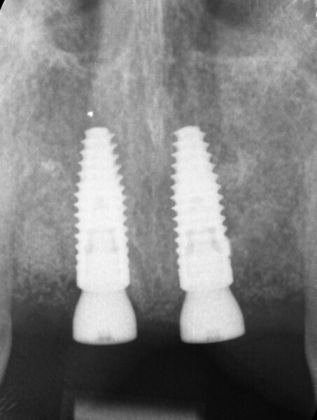 Fig. 12: Intra-oral radiograph of the implants after placement.