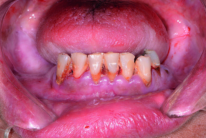 Fig. 13: Mandibular arch anaesthetised.