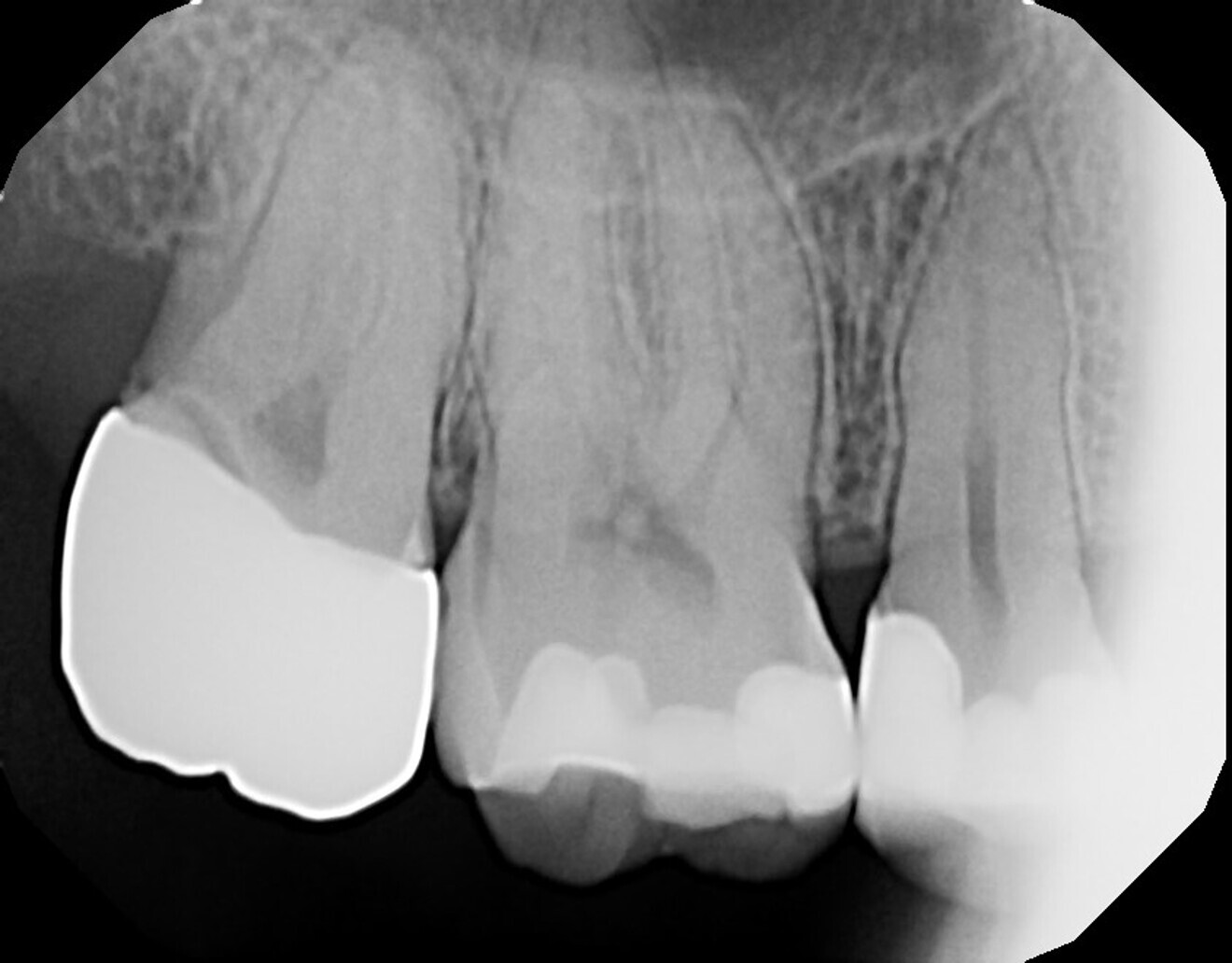 Fig. 12: Periapical radiograph five years after laser pulpal treatment and restoration of the tooth, demonstrating no periapical pathology.