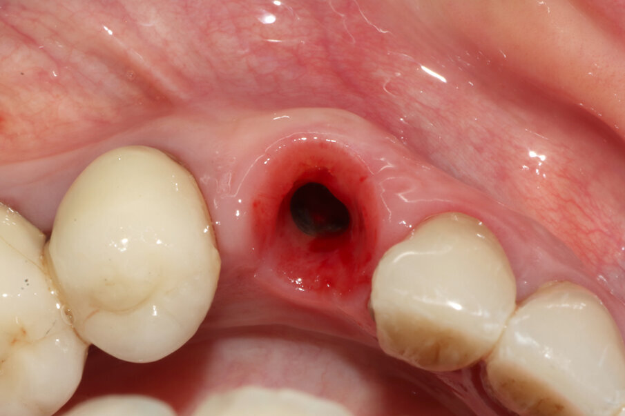 Figg. 16, 17_Visione occlusale dei tessuti guariti e alla consegna della corona; si noti il mantenimento della bozza canina.