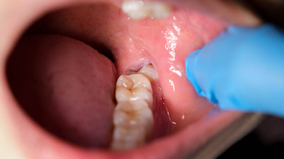 Singapore dentists debate new competency pathway for third molar surgery