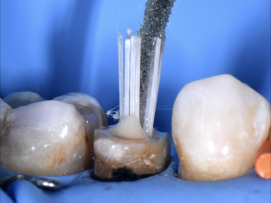 Fig. 2: Los postes individuales se disponen de forma uniforme en el espacio para el poste, a fin de ajustarlos con precisión a la geometría del conducto radicular. Un espaciador puede ayudar a la disposición uniforme de los postes individuales, para lo cual el autor eligió un pincel de aplicación Endo Tim.