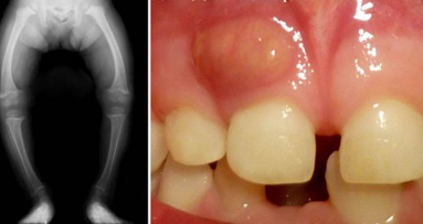 Une lueur d´espoir dans le traitement du rachitisme