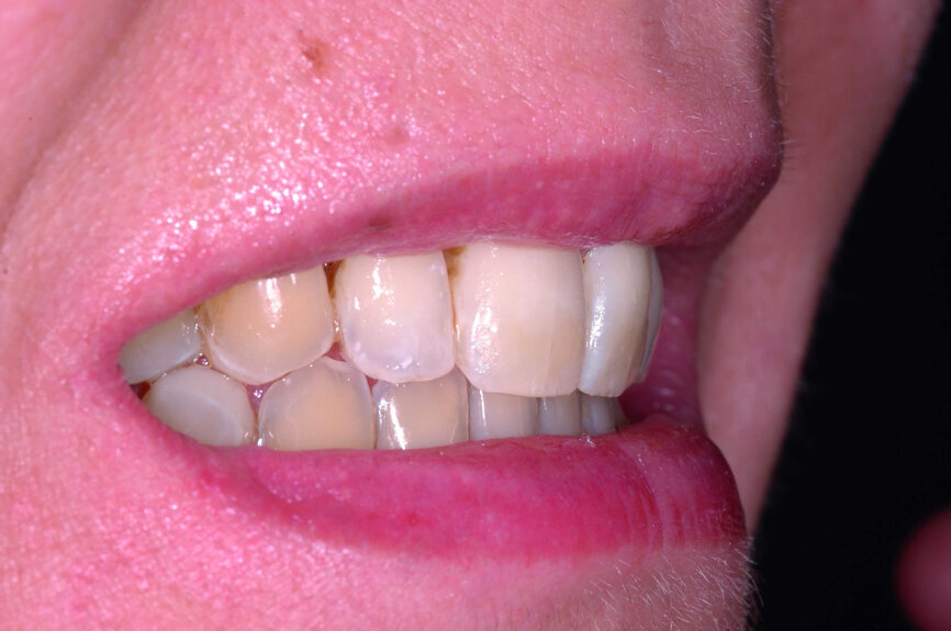 Fig. 20 : Sourie final, vue latérale.