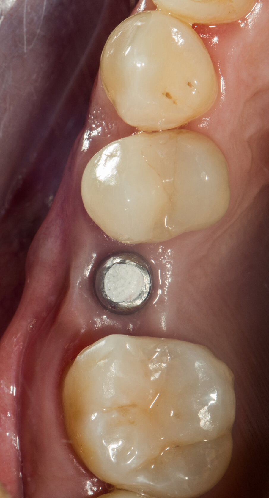 Fig. 26 - Vista occlusale prima della cementazione del manufatto protesico.