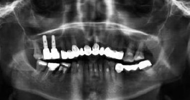 Augmentacja dna zatoki szczękowej bez użycia wytwarzanych komercyjnie biomateriałów