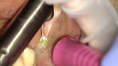 Odsłonięcie implantów przy użyciu lasera Er:YAG