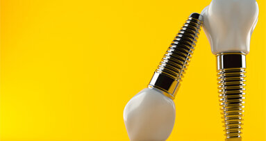 Trends in dentistry: What is currently happening in implantology?