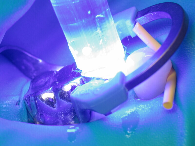 Fig. 9 : Photopolymérisation de l’adhésif.