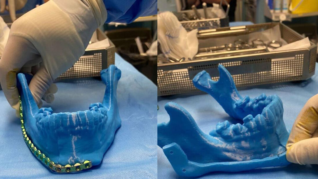 Surgeons in Tabuk reconstructed the jaw of 25-year-old patient with 3D printing