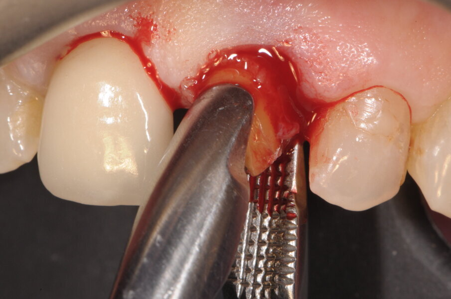 Fig. 3 - Estrazione della radice eseguita con particolare attenzione al ridotto traumatismo del tessuto osseo e mucoso circostante.