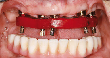 Nepřímá metoda pro ošetřování prostřednictvím provizorií