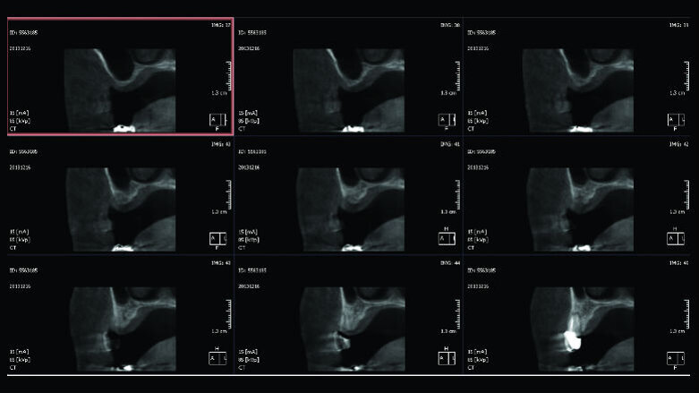 Rialzo di seno con accesso laterale e innesto di impianti autofilettanti SPI in mascellare atrofico