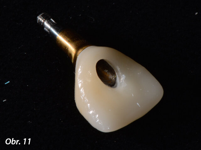 Hotová korunka, pohled z palatinální strany.