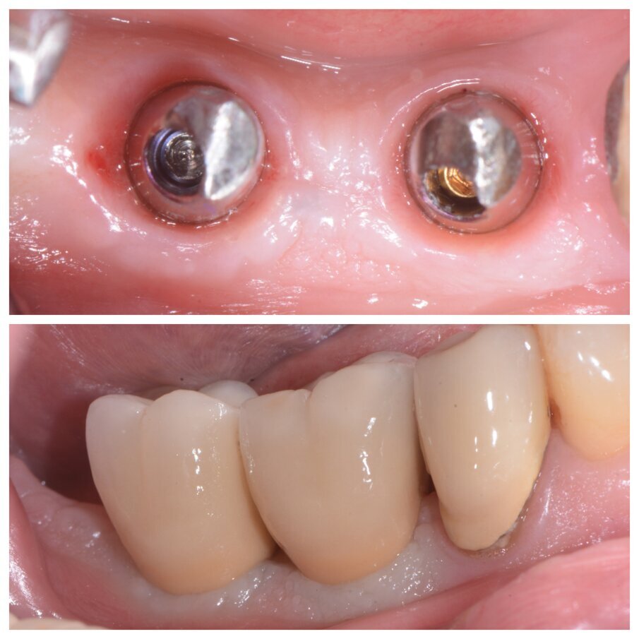 Fig. 1e_Condizionamento tessuti molli e protesi definitiva.