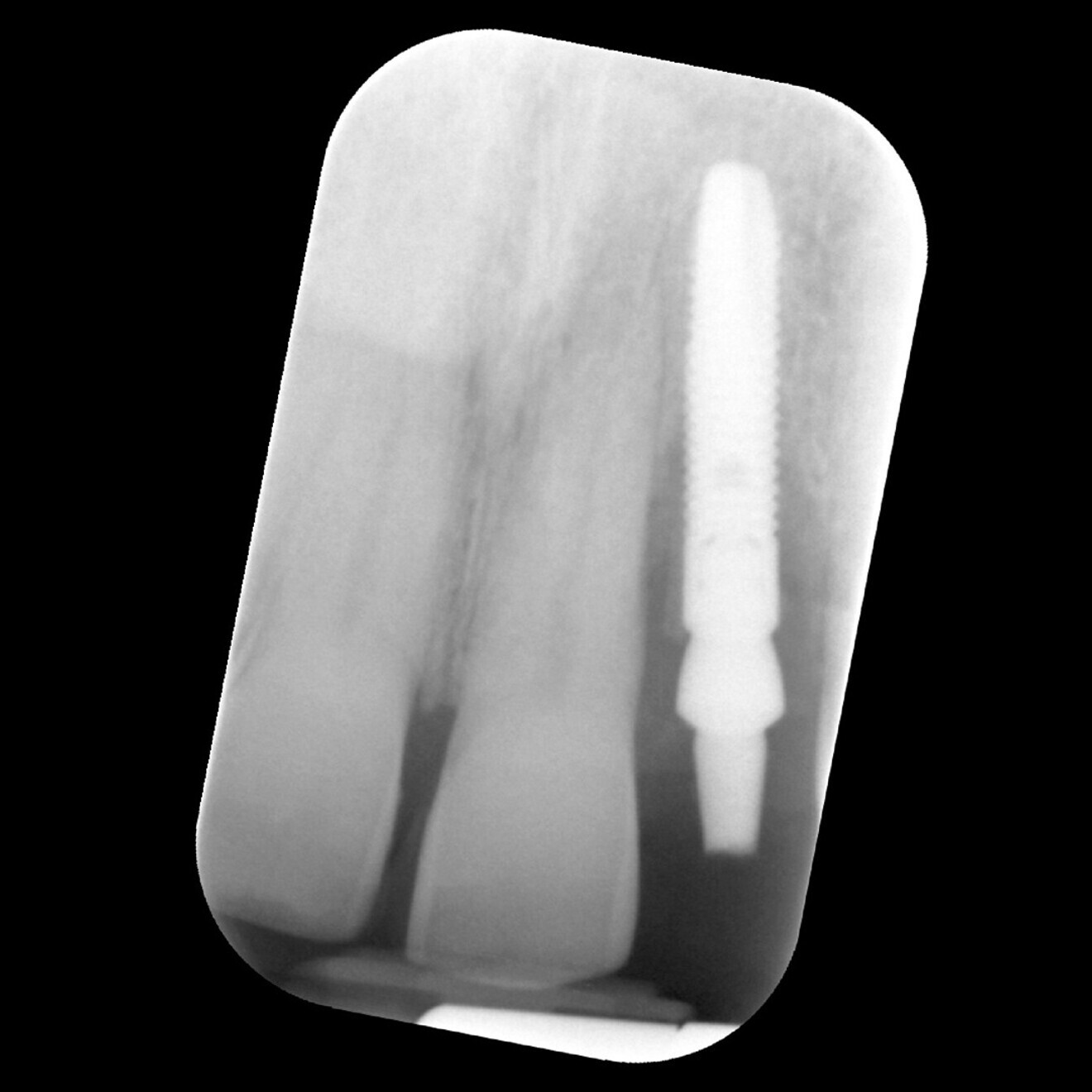 Fig. 17: Radiograph of the implant after three months of osseointegration, showing significant cratering of the crestal bone.
