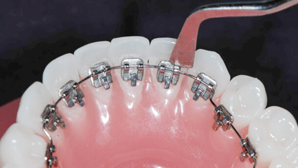 Curso de  Ortodoncia Lingual: El Método Directo 2D: Fácil y Asequible