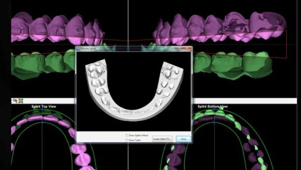 Systemy CAD/CAM w zabiegach korekcyjnych szczęk w chirurgii ortognatycznej