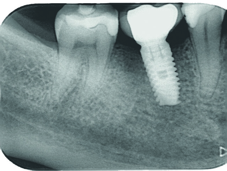 Fig. 28 : Contrôle radiographique de la couronne et de son pilier titane. Les niveaux osseux sont maintenus au niveau de la base du col du pilier.