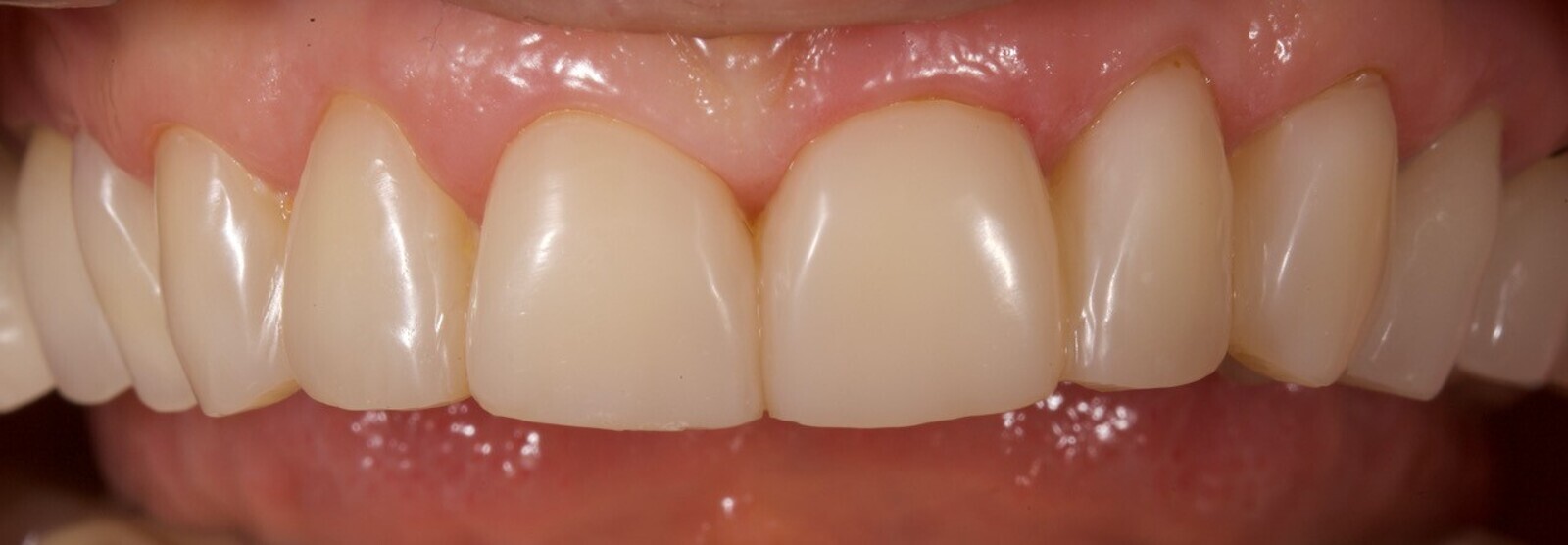 Fig. 15a: Appearance at the six-month recall. Frontal view of the maxillary teeth.