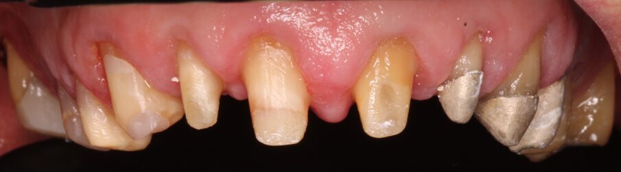 Fig. 8: Composite build-ups on teeth 12, 11 and 21 and cast build-ups on teeth 22, 23 and 24