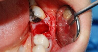 Utilizzo di osso bovino decellularizzato e delipidato e di una membrana in pericardio