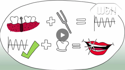 W&H – When is an implant osseointegrated?