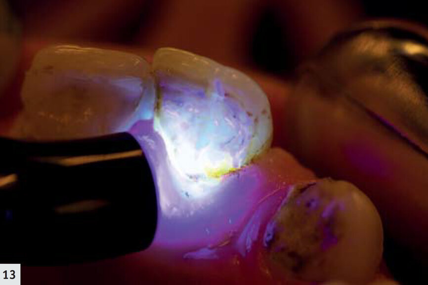 Fig. 13 : Fluorescence rouge émise par le biofilm proche du rebord gingival, ce qui indique un risque d’inflammation parodontale. 