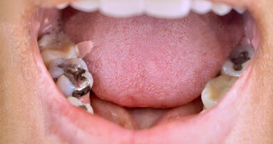 WHO advances action on dental amalgam phase‑out across Southeast Asia