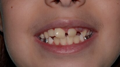 An Unerupted Maxillary Permanent Central Incisor and its Multi-Faceted Management