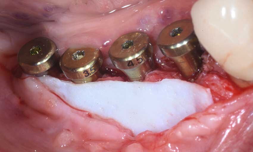 Fig. 11 - NovoMatrix in posizione.