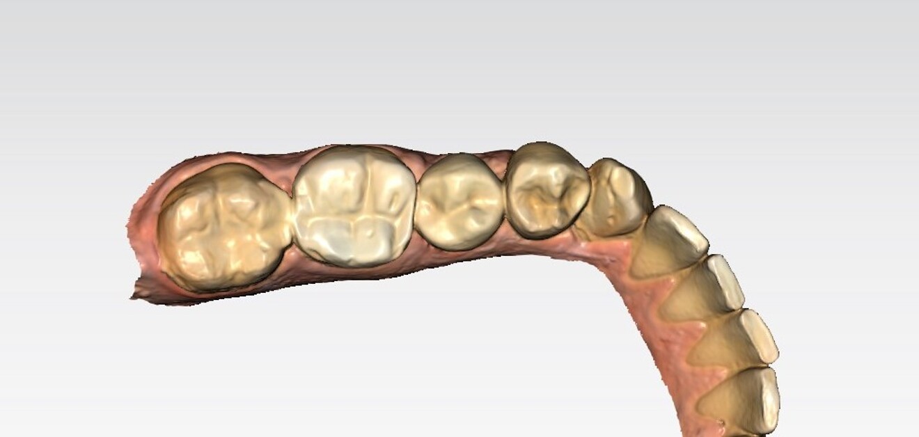 Fig. 15a: Initial intra-oral scans of the mandibular left quadrant.