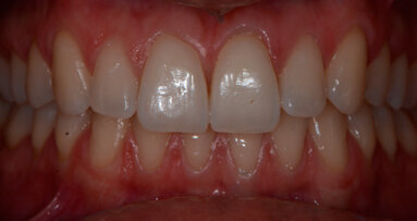 L’adherence ai protocolli operativi di prevenzione con approccio clinico D-BIOTECH (Dental BIOfilm Detection Topographic Technique)