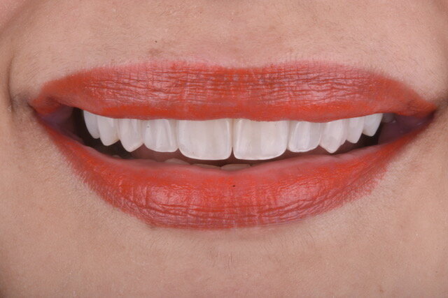 Fig 3B: Frontal smile view: After