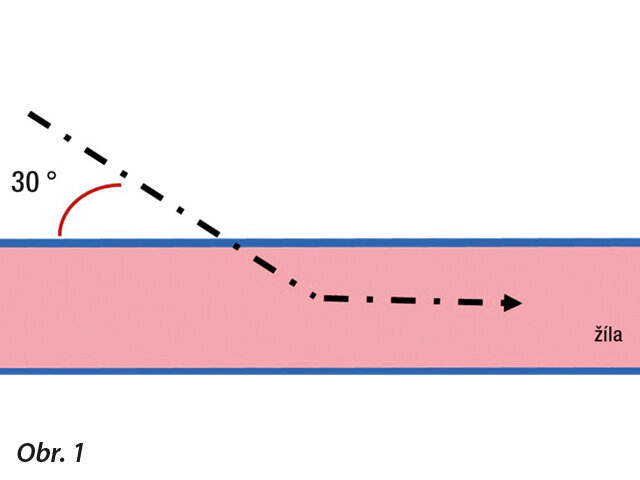 Vizualizace směru vpichu při odběru krve.