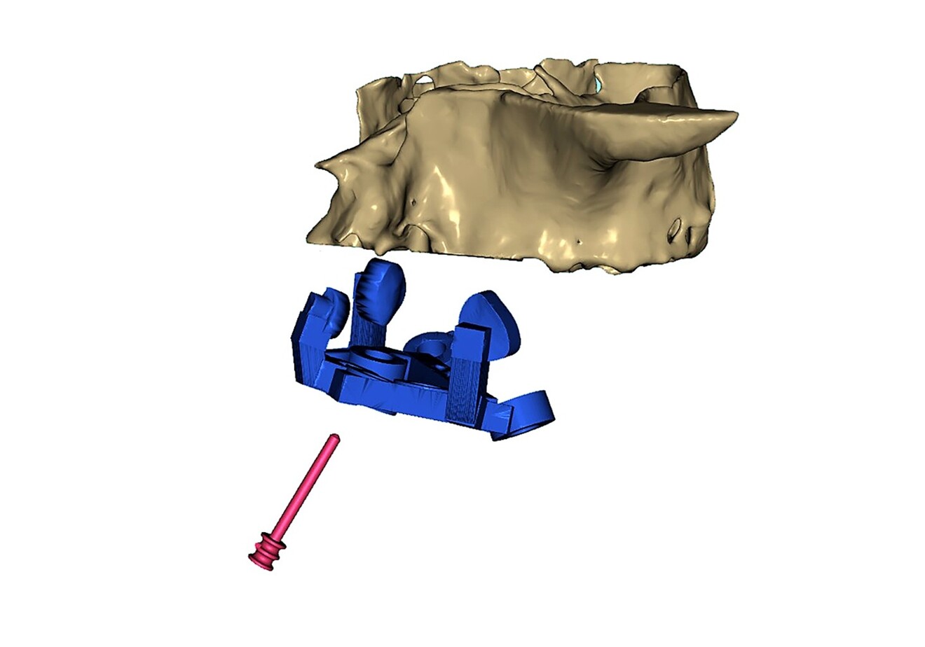 Fig. 9: Exploded view of the nasopalatine canal pin, the nasopalatine canal pin guide (blue) and the maxillary bone showing anterior bony concavities.