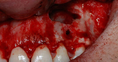 Gli emocomponenti in chirurgia orale: esperienza della scuola di Torino