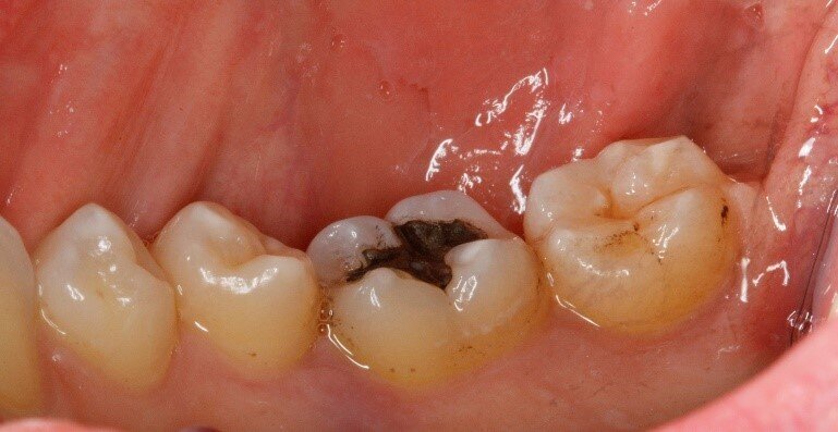 Fig. 5b - Controllo dopo un mese.