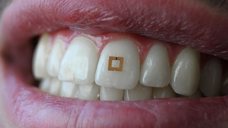 Microchip op tand meet inname suiker, zout en alcohol