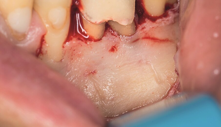 … the limits of the cortical window were marked in the bone (f) …