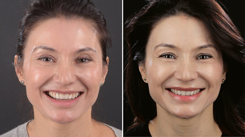 Preoperative digital planning