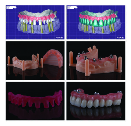 Kolaž slika 3:  Dizajniranje master modela, isprintani master model i konstrukcija. Definitivni izgled hibridnog mosta.  (U saradnji sa dr Bojanom Golić, Stomatološka ordinacija Dental Studio). Isprintano na 3D printeru DWS XFAB 2500 u saradnji sa Tim Co.