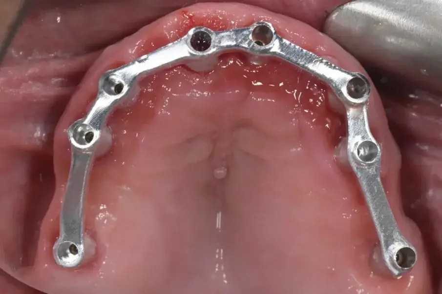 Фиг. 15: Интраорален тест на металната лента за оценка на точността и пасивното прилягане.