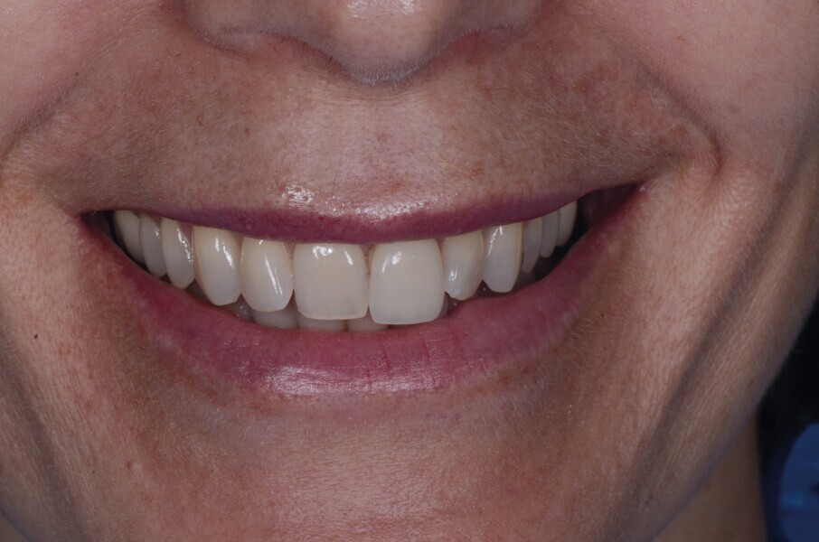 Fig. 1b : Vue préopératoire extraorale : lèvres au sourire 