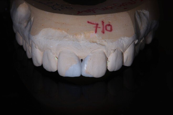 Fig 4 Wax up