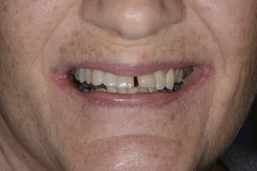 Figs. 4a–d: Deep bite with anterior flaring and diastema.