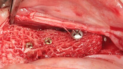 Webinar: Customized allogenic bone blocks improve outcome in bone augmentation