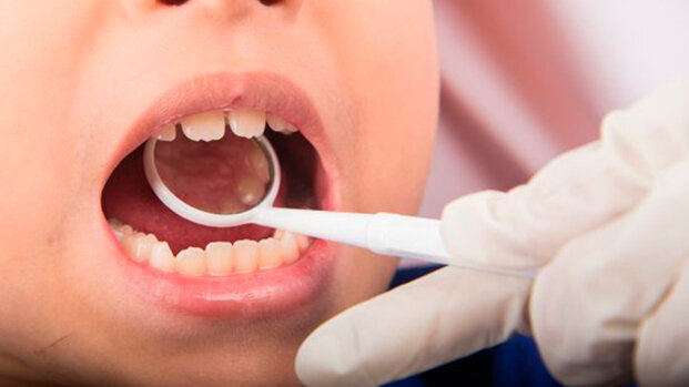 Preventiva zubnog karijesa - komparacija zalivanja i fluoridnih lakova